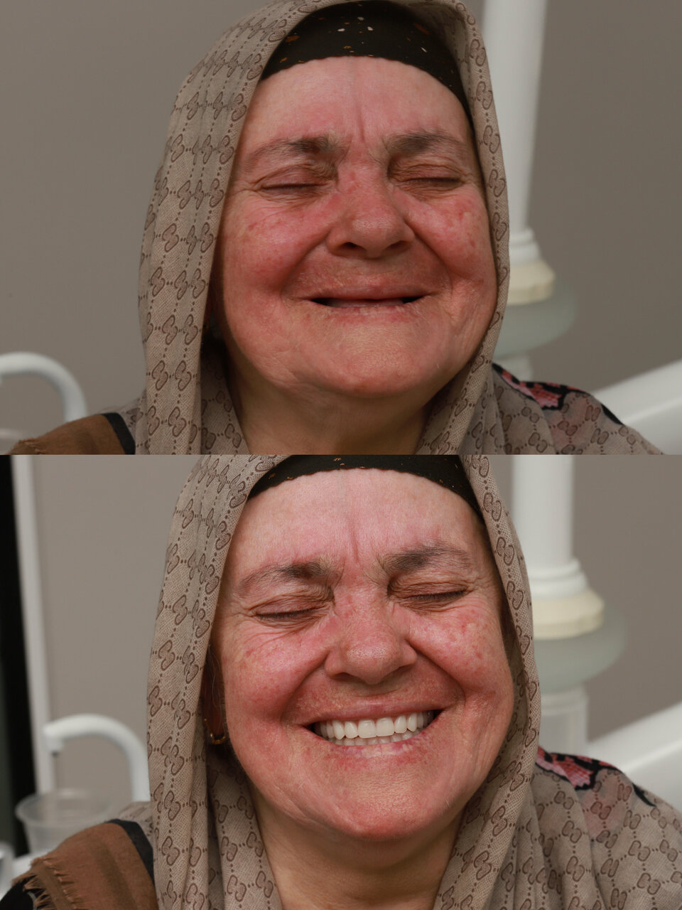 Улыбка пациента до и после