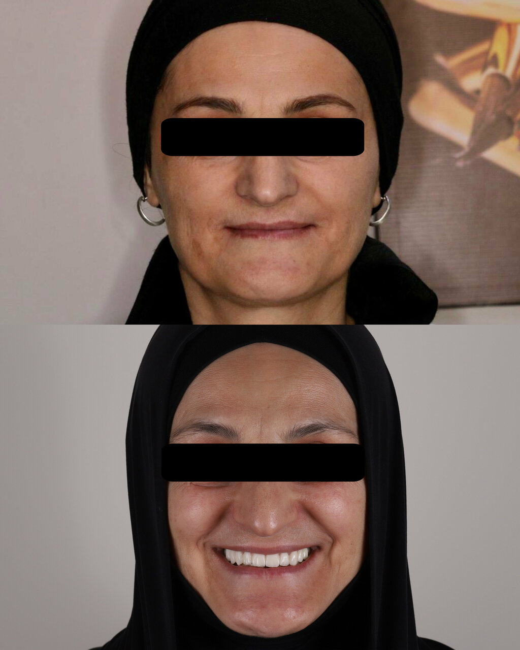 Улыбка пациентки до и после